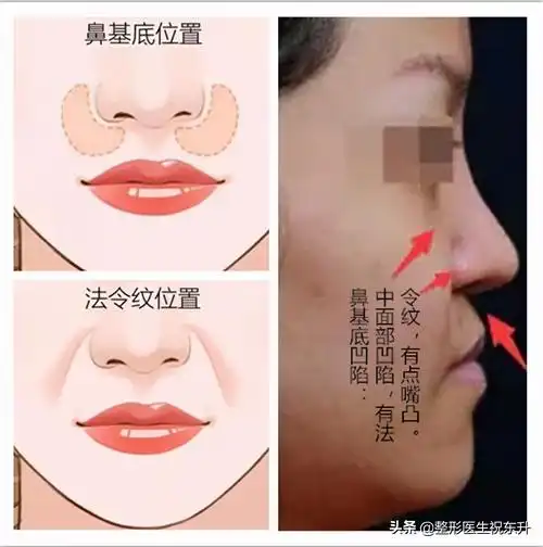1,鼻基底凹陷如果轻轻就有法令纹,很可能存在鼻基底凹陷,如果确定是鼻