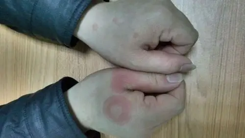 环状红斑的疾病诊断