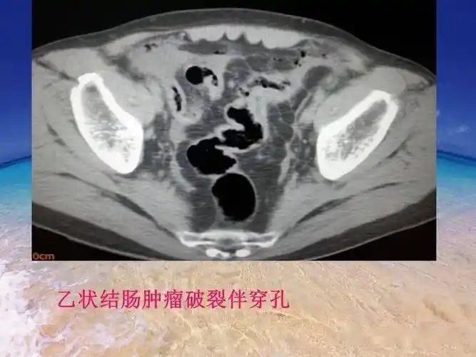 消化道穿孔ct影像大汇总看完印象深刻