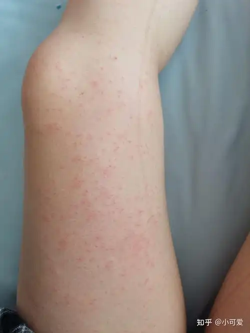 膏药过敏引发的过敏性皮炎治疗心酸历程(有图做好心里准备)