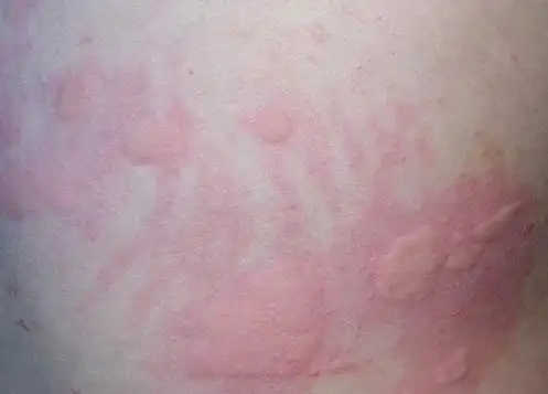 皮肤过敏怎么办【相关词_ 皮肤过敏怎么办偏方】