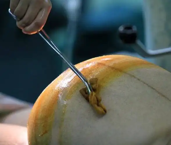 麻醉师对孕妇进行半麻手术