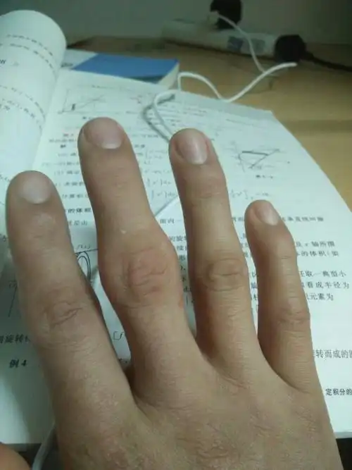 手指头关节肿大有什么办法吗?