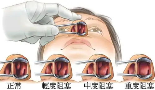 鼻腔内部病变比较