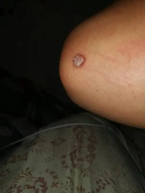 手臂肘部关节处长了个疙瘩,请问是什么症状,怎么处理