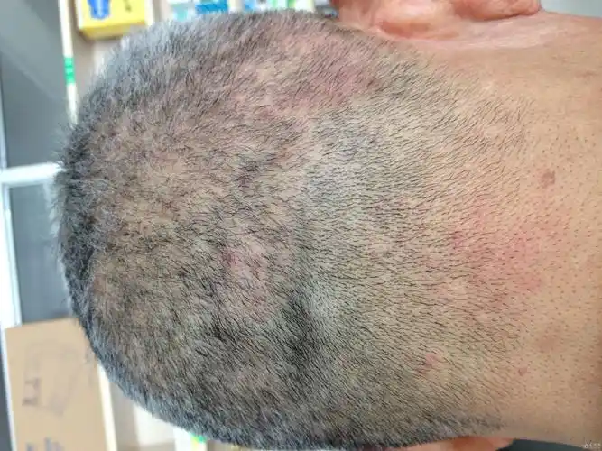 皮肤瘙痒头部多发性丘疹