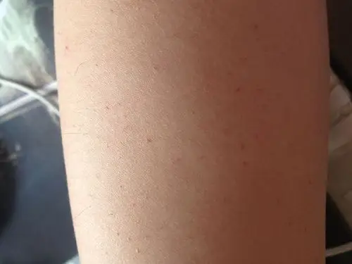 皮下出血,很小的小红点.