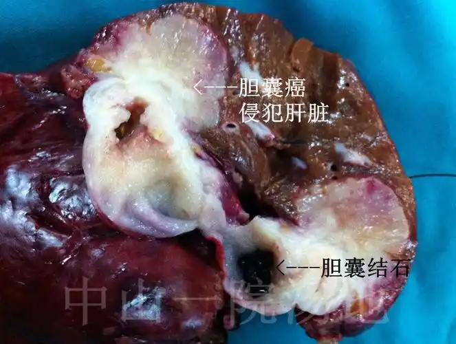 胆囊癌--莫让良性疾病演变为癌症时才追悔莫及.