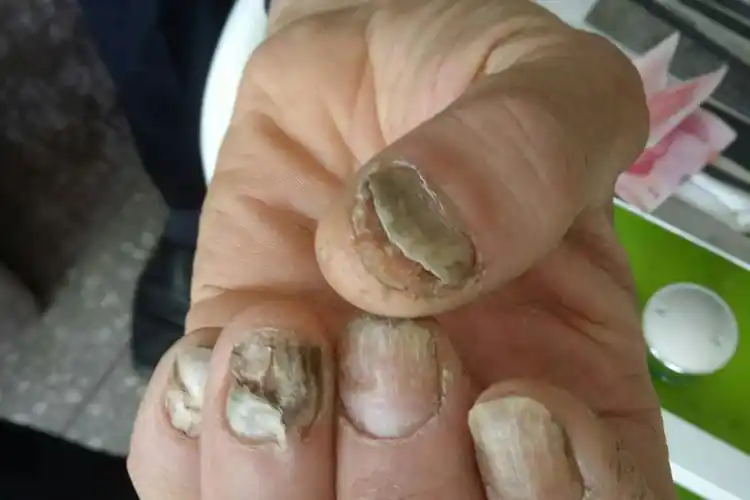 手部全甲毁损型甲癣图