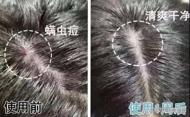 床上螨虫扎堆教你个笨法子屋里放点它螨虫全跑光了