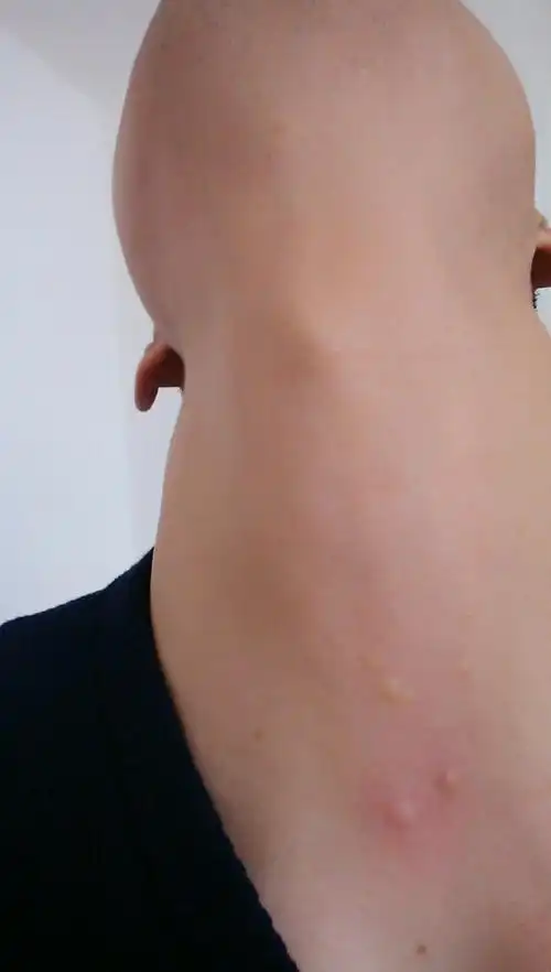 跪求脖子上的疙瘩是怎么回事,皮下的,米粒大小,硬的