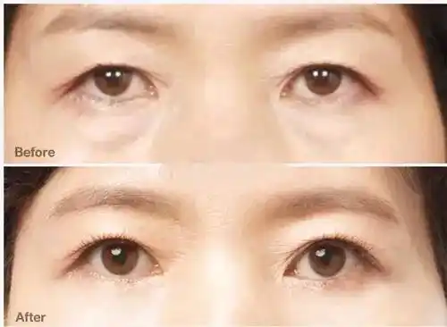 年龄增长双眼皮下垂是为什么怎么解决