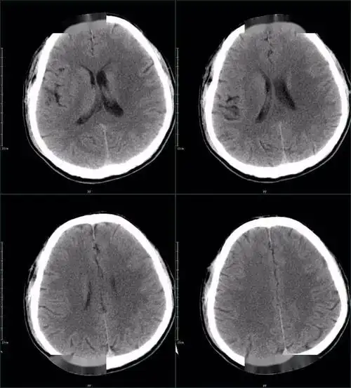 67超急性期大面积脑梗死ct平扫表现