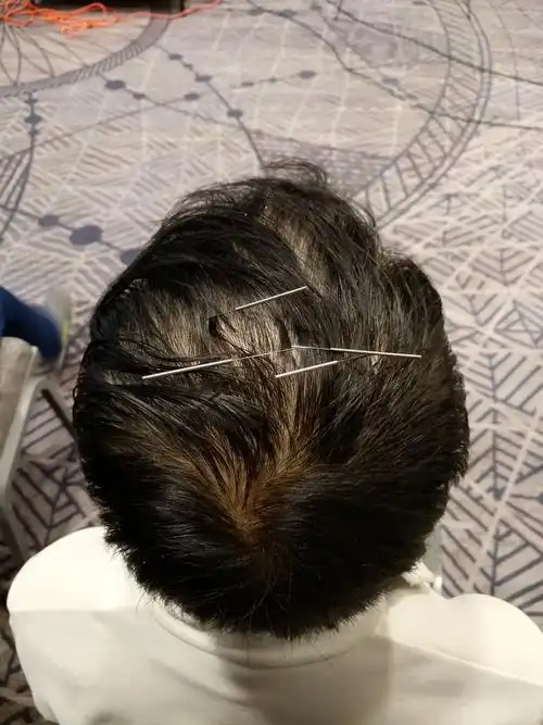 焦氏头皮针治疗皮肤骚痒