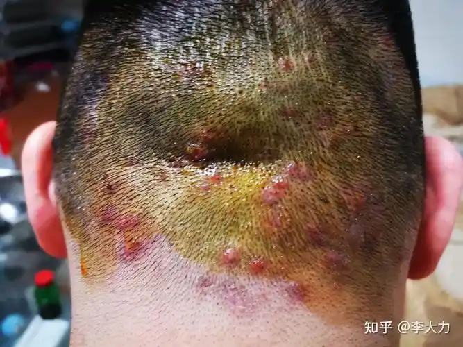 疖子是什么原因引起的(小孩长眼疖子是什么原因引起的)