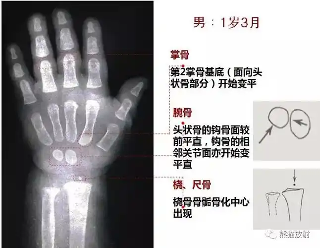 上图中的数字为相应骨时的年龄青春期和以后,着重对比骨骺端融合过程