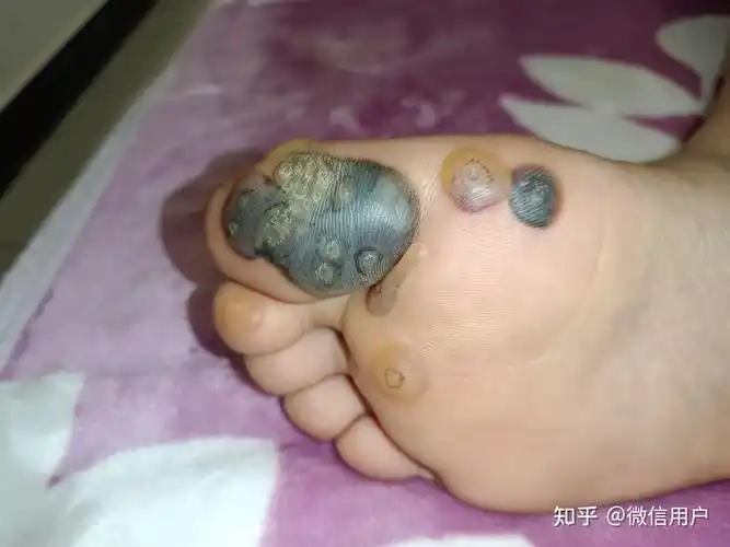 跖疣液氮冷冻恢复过程未完结