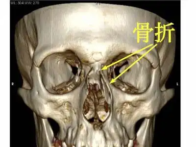 鼻梁上段塌陷或偏斜,皮下瘀血,x线鼻骨拍片或ct扫描可以显示骨折位置