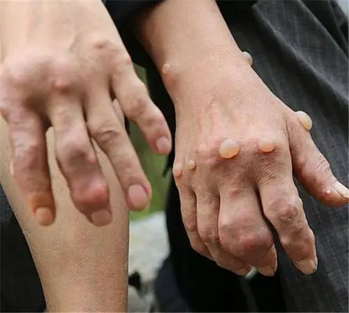 痛风石对双手的影响图片