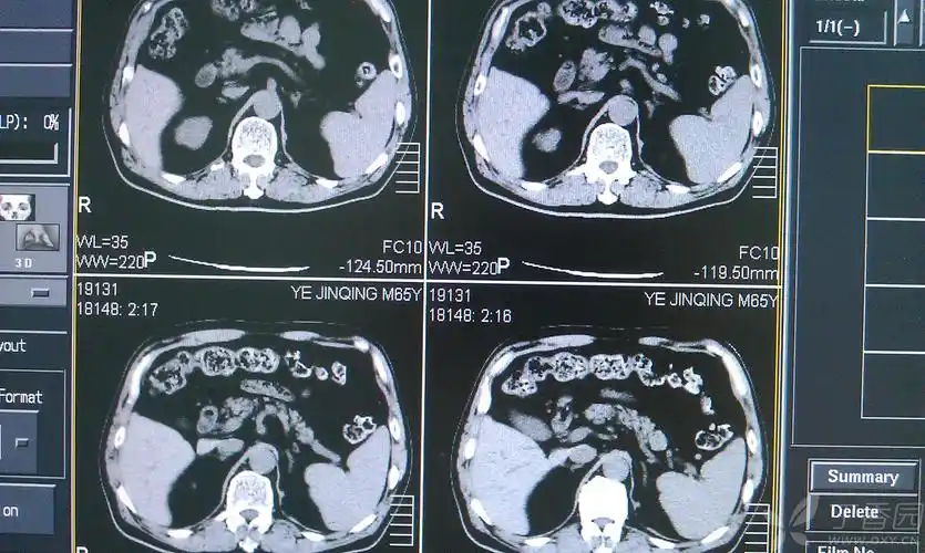 【请教】肾积水?