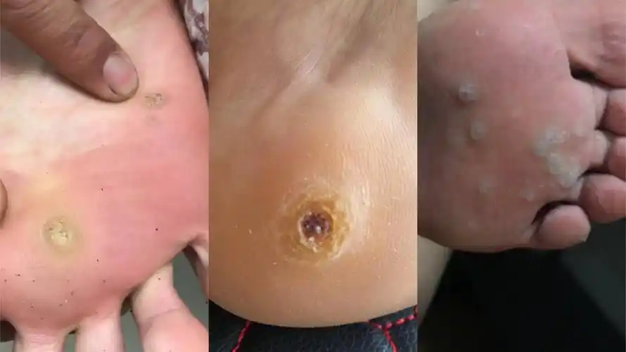图文并茂鸡眼和跖疣的区别一看就懂