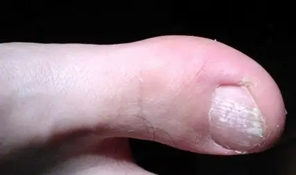 脚指甲 白色 一层请告诉我,是怎么回事呢?怎么办?