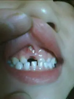 门牙牙根没掉 牙龈上长出新牙