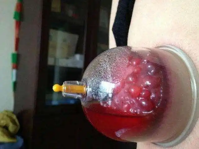 世界艾乡资讯-拔火罐时,吸出的瘀血就是体内的毒素吗?医生说出大实话-