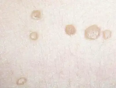 扁平疣的症状及消退