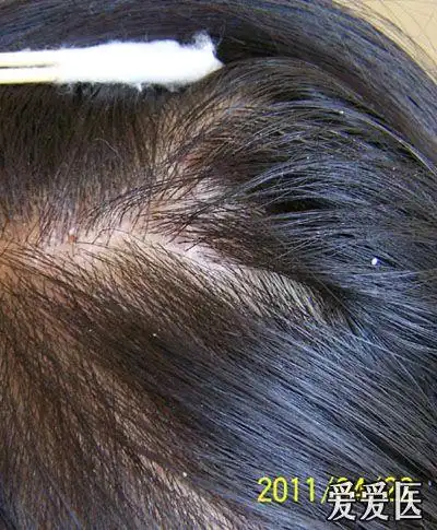 小儿头癣的种类及其症状防治儿童头癣的症状和治疗方法