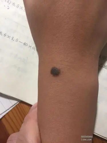 5岁娃要开黑色素痣了,有人了解的吗?39楼有图