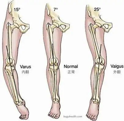 膝内翻俗称o型腿布骨详解膝内翻的病因诊断症状及如何治疗