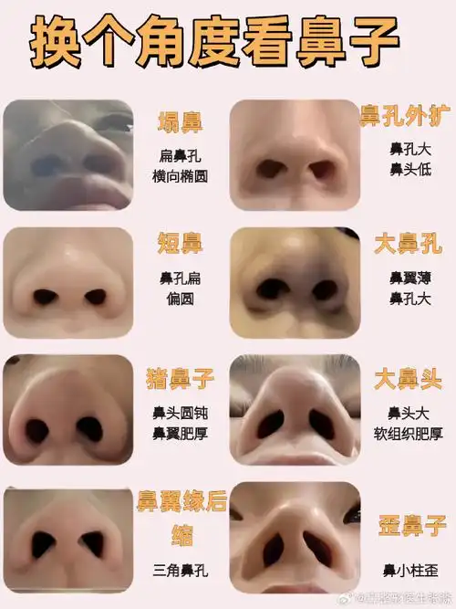 朝天鼻##短鼻##鼻翼肥厚##鼻翼切除##鼻孔外露##鼻翼缘退缩##大鼻孔