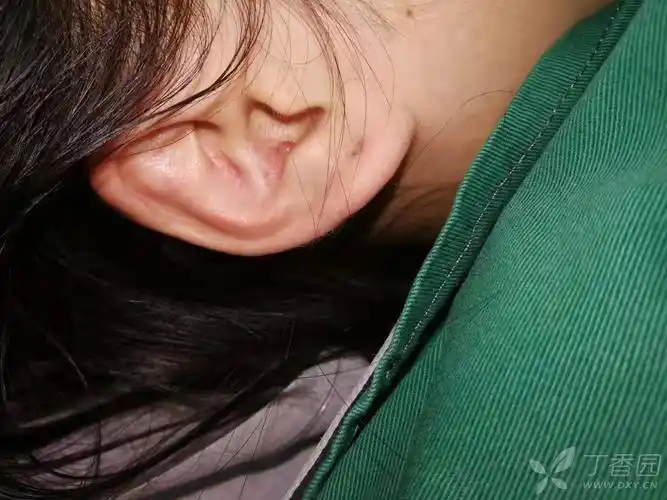 【讨论】取耳软骨后疤痕增生怎么处理?