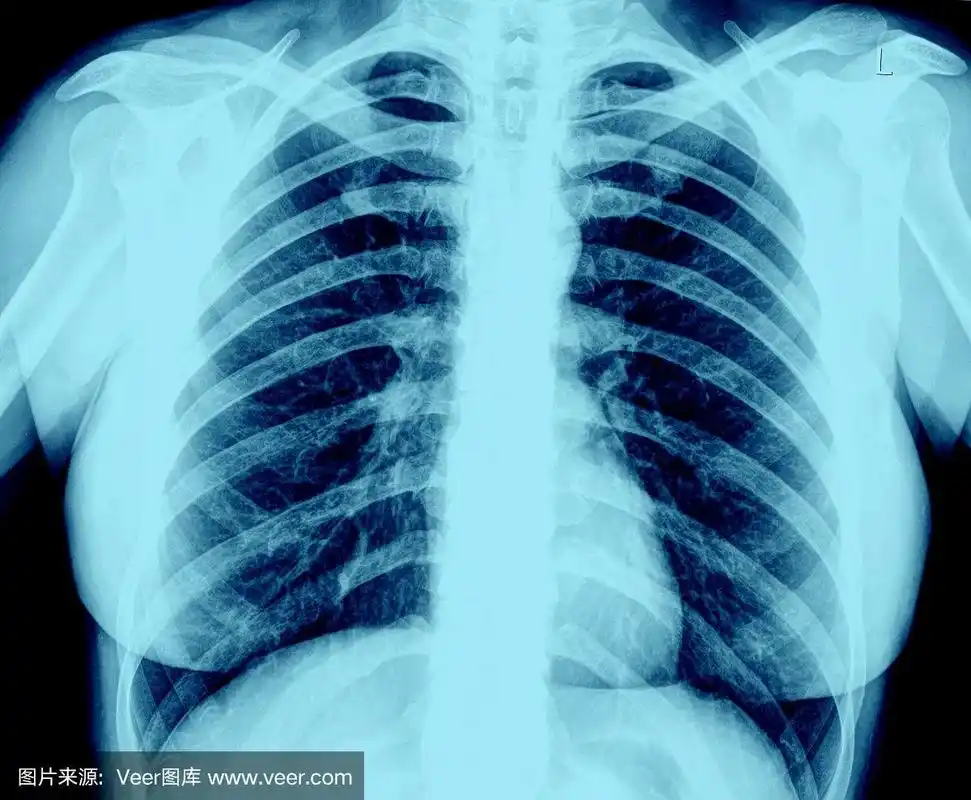 肺部x光
