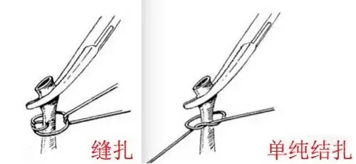 美篇(8) 贯穿缝扎(suture ligation) a) 要点:将钳夹组织的血管钳平放