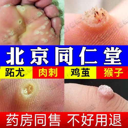 跖疣专用涂药膏去除足部脚底趾疣去祛根hpv脚上鸡眼石疣膏寻常疣拓趾