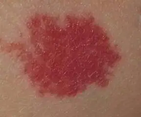 你的孩子身上有胎记吗