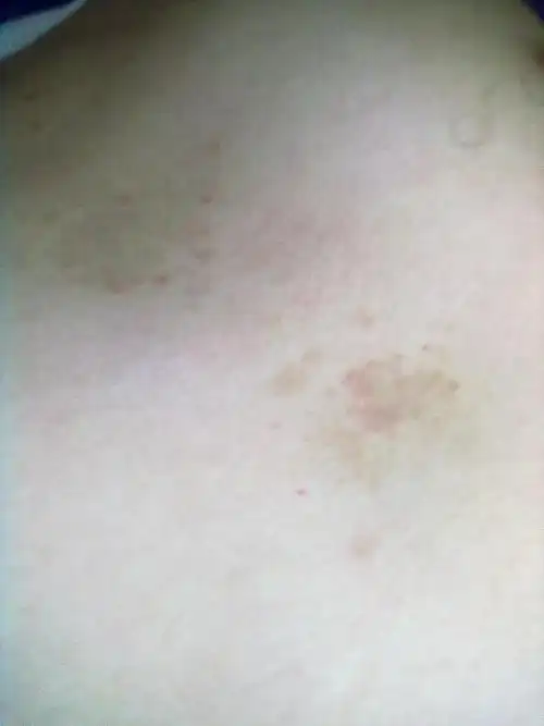 有比较专业的医生之类懂医理知识的么,请问一下,胸前的这种红色斑点是