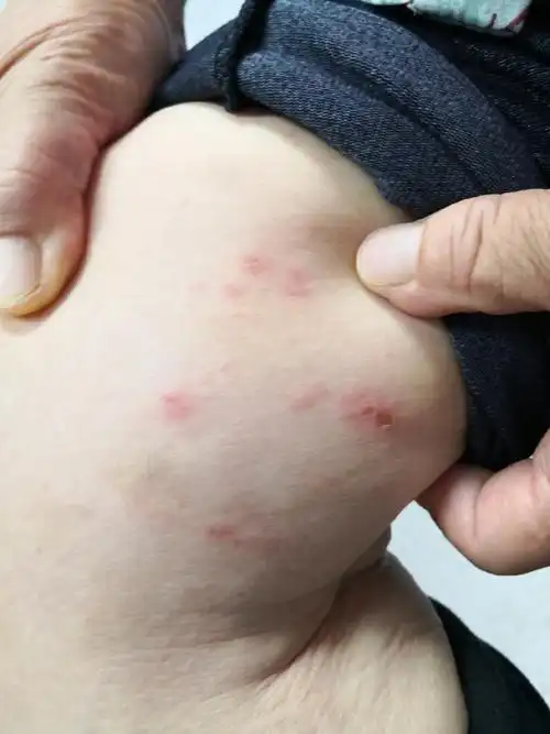 带状疱疹##解决皮肤问题专注皮肤美容