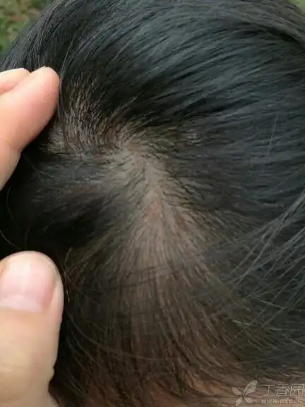 请问最近发现头皮有褐色斑块.这个是脂溢性皮炎么? [病例帖]