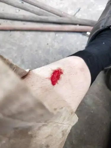 脚碰破皮了,走路感觉到涨,需要去上药吗