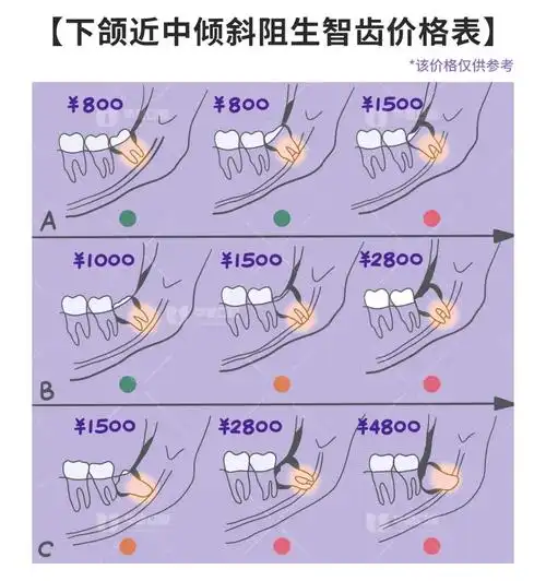 智齿与下颌神经管位置越近的,拔除费用越贵;智齿牙根越多的,拔除费用