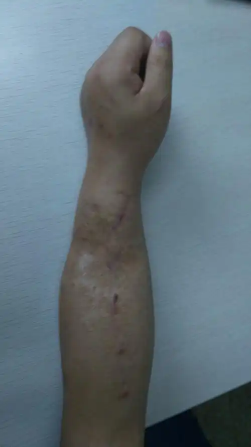 上肢畸形矫形病例展示—前臂枪伤畸形愈合30年-手功能