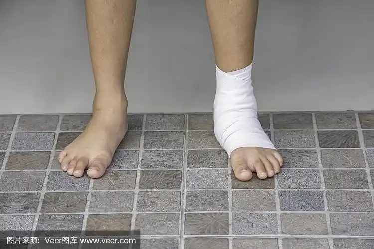 踝关节周围的纱布绷带和腿部因发炎而肿胀.