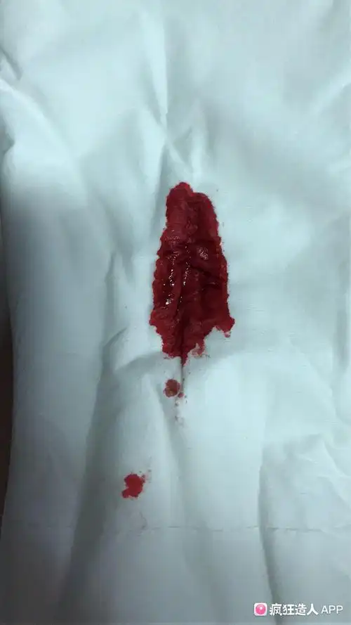 怀孕初期,出这样的血孩子还能保住吗?