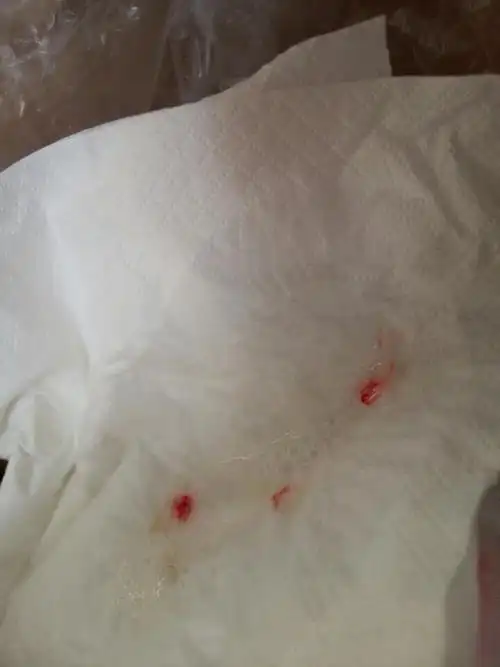 从喉咙里老是吐血丝 如图,鼻子也出血,是怎么回事