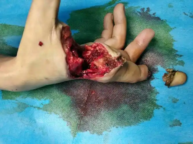 一男性患者,因工作期间疲劳操作致右手掌不全离断及示指末节挤轧性离