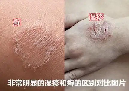 患有湿疹的人通常具有遗传性的发展过敏性疾病的可能,还有压力和环境