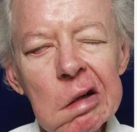 31,十日根治面瘫(歪嘴风)